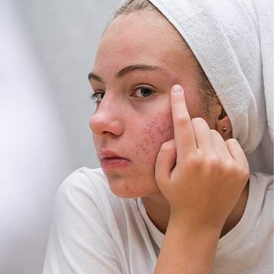 Acne Scar