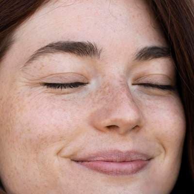 Melasma