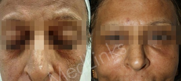 anti-ageing-before-after