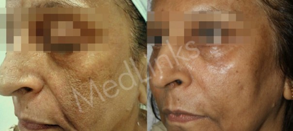 anti-ageing-before-after-2