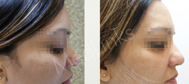 nose-reshaping-before-after8