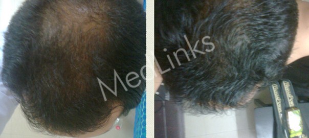 PRP-before-after-1