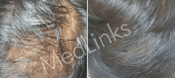 PRP-before-after-2