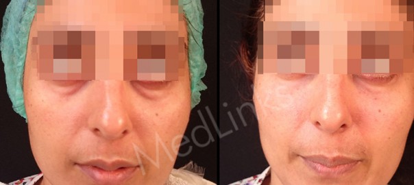 skin-rejuvenation-before-after