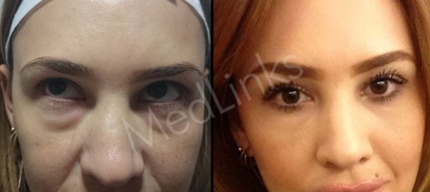 skin-rejuvenation-before-after-1