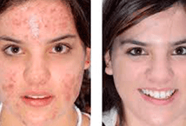 acne-treatment-before-after