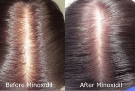 micro-minox-before-after