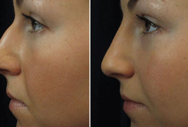 nose-reshaping-before-after