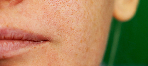 How to get rid of open pores