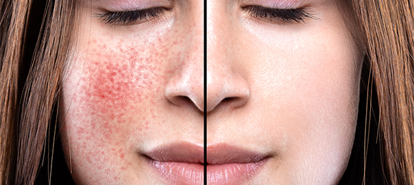 Rosacea Types Causes and Treatments