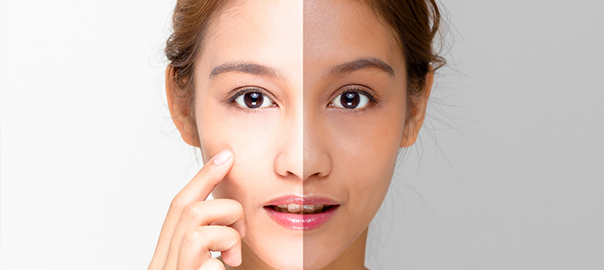 Skin Lightening Treatment to Get Radiant Skin on New Year