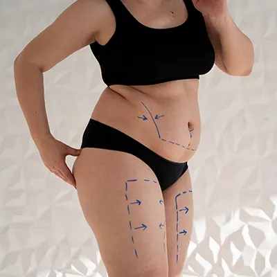 Liposuction