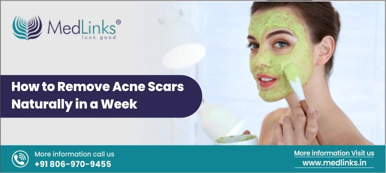 Expert Tips to Remove Acne Scars Naturally in a Week