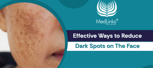Dark Spots Treatment in Delhi and Gurgaon