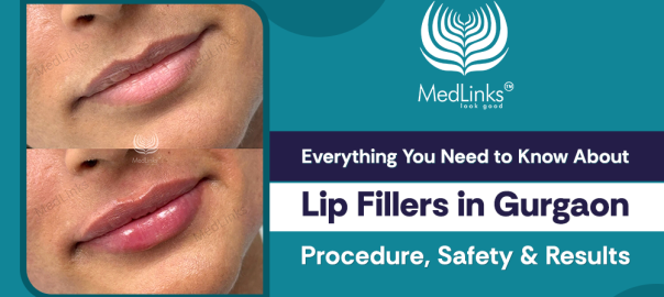 Lip Filler Treatment in Gurgaon, MedLinks, Lip FIller