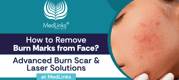 How to Remove Burn Marks from Face