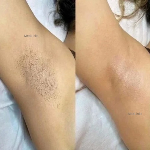 Full body laser hair removal treatment for long-lasting hair reduction and smooth skin