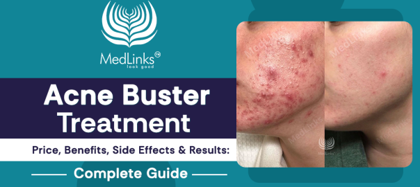 Acne Buster Treatment for Acne Removal with Benefits, Results and Side Effects Guide
