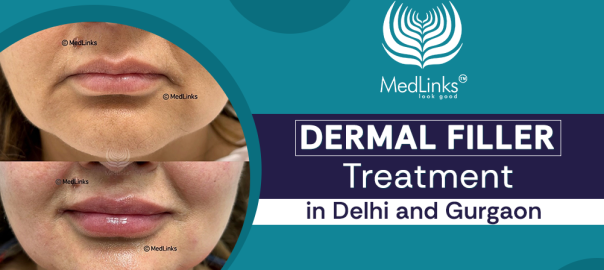 Dermal filler treatment in Delhi and Gurgaon for natural facial volume restoration at MedLinks